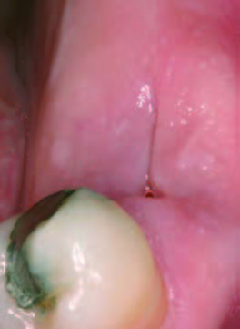 PRGFあり15日後歯肉の状態