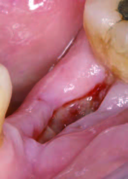 PRGFなし15日後の歯肉の状態