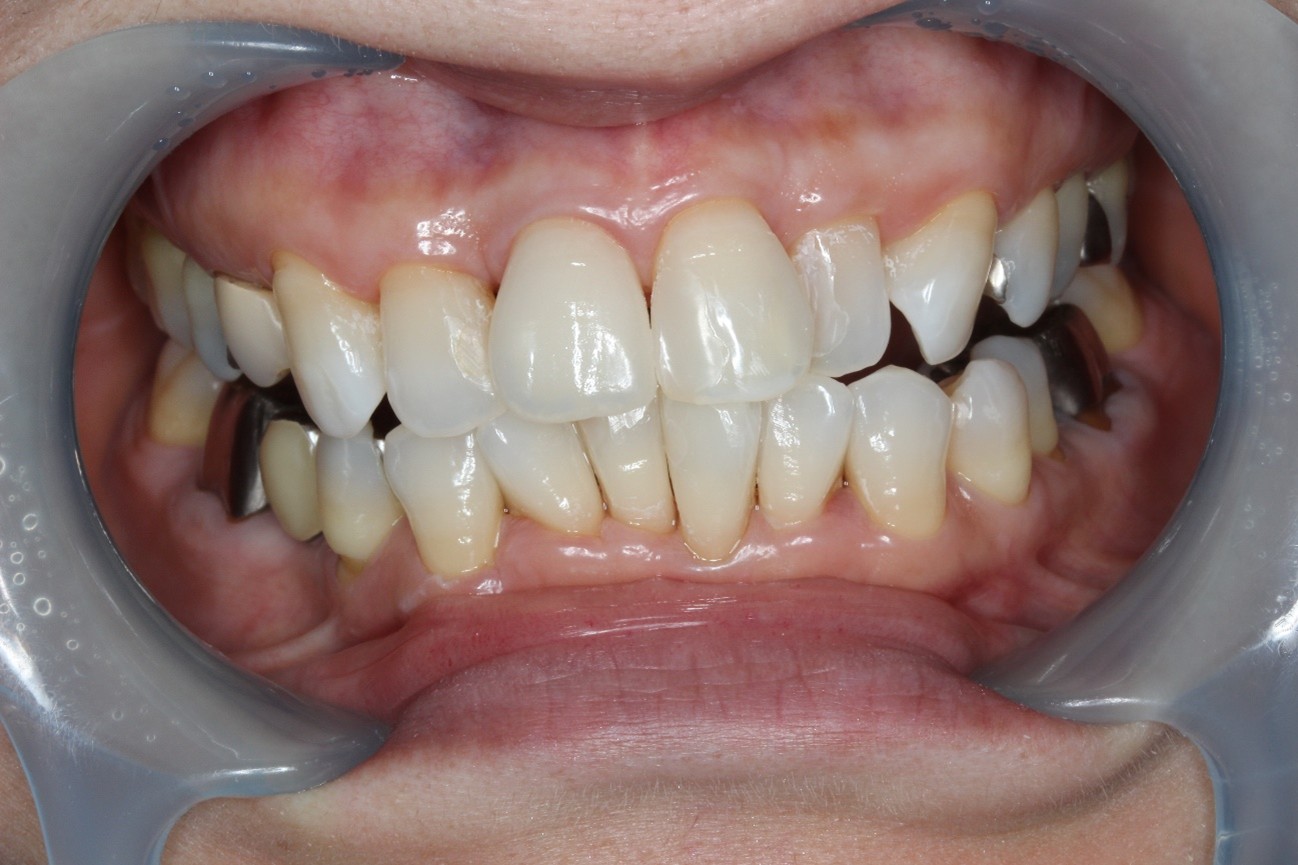 セラミッククラウン+ホワイトニング症例After