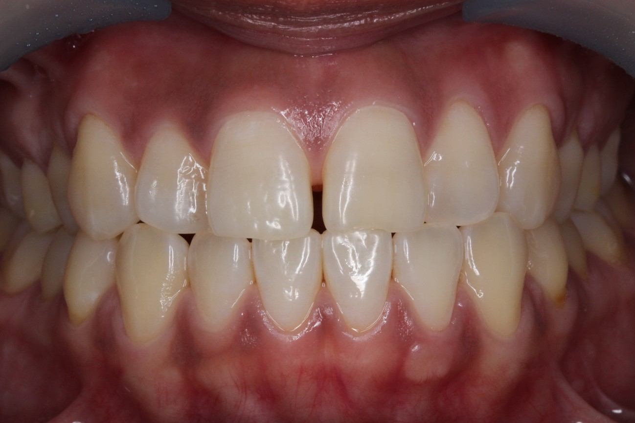 ダイレクトボンディング前歯症例Before