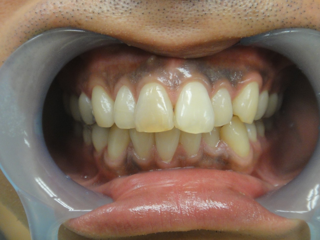 ガムピーリング症例Before