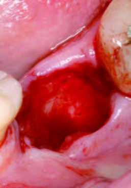 PRGFなし抜歯直後