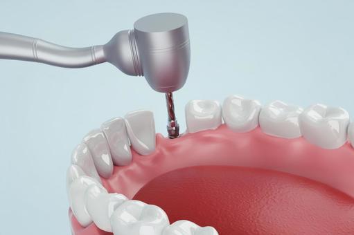 インプラント埋入のイラスト