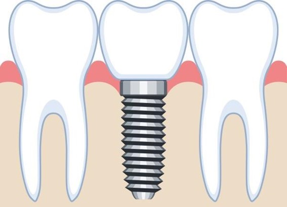 インプラントイメージ